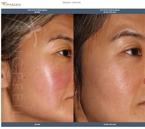Rosacea Treatment And Medication Philadelphia Rosacea Laser Therapy Pa