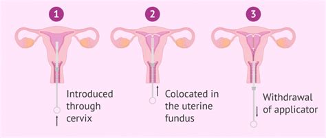 how does the iud work and what are the pros and cons