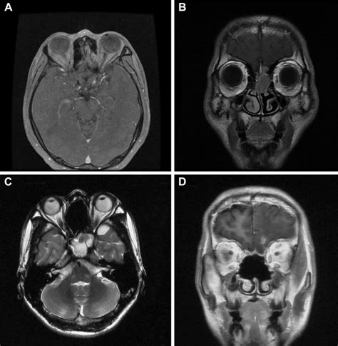 Representative Mri Scans Of A Patient With Olfactory Neuroblastoma