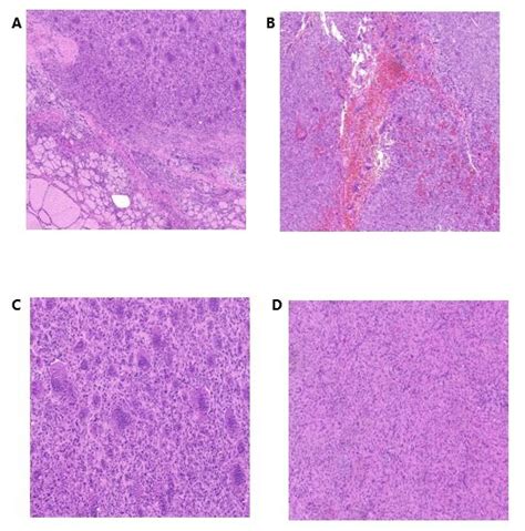 Histological Features Of Thyroid Gct St A Mononuclear Stromal Cells