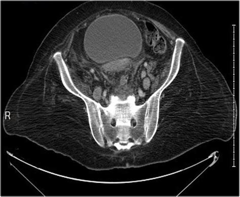 Axial Ct Scan Of The Pelvis Shows Multiple Enlarged Lymph Nodes Seen