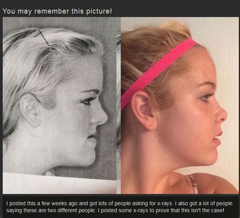 Before And After Jaw Surgery 12 Pics