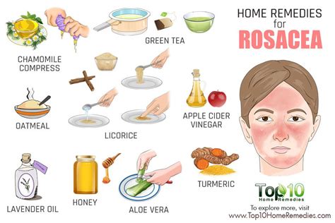 Home Remedies For Rosacea What You Should Use Top 10 Home Remedies