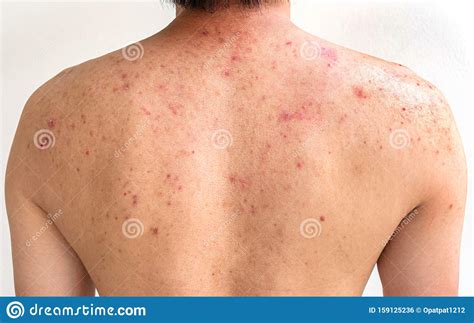 Men With Acne With Red Spots On The Back Stock Photo Image Of