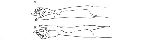 Illustration Of The Incisions Used To Decompress The Volar Forearm