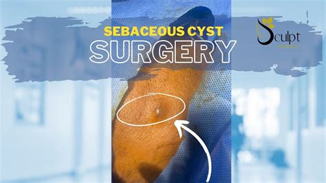Sebaceous Cyst Treament Sebaceous Cyst Removal Cost Sebaceous Cyst