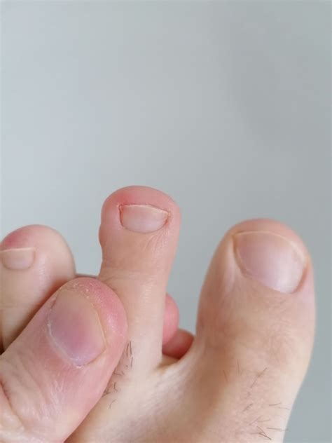 Toe Infectionrash What Is This Foot And Toe Problems Forums