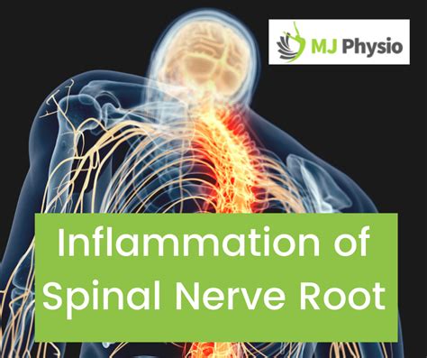 Inflammation Of A Spinal Nerve Root Mjphysio
