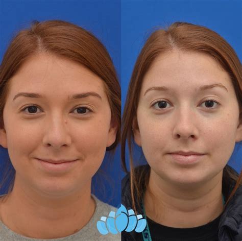 Scar Revision And Mole Removal Before And After Photo Gallery Charlotte