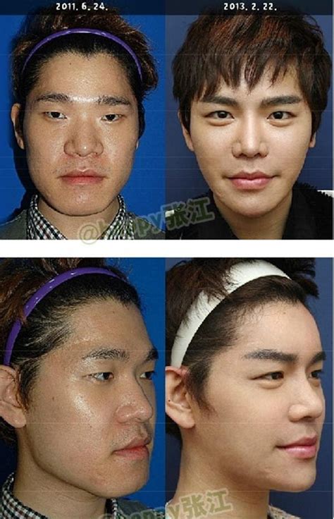 South Korea Tops Plastic Surgery Tables Again ~ Fact Information Truth