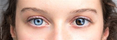 Human Heterochromia On Eyes Of Girl Blue One And Brown One Stock Photo