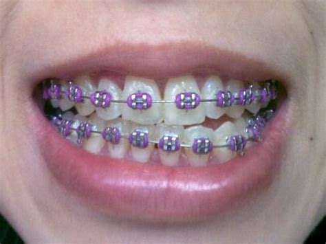 How To Choose Good Brace Colors That Best Suits You Ivanov Orthodontic Braces Colors Dental