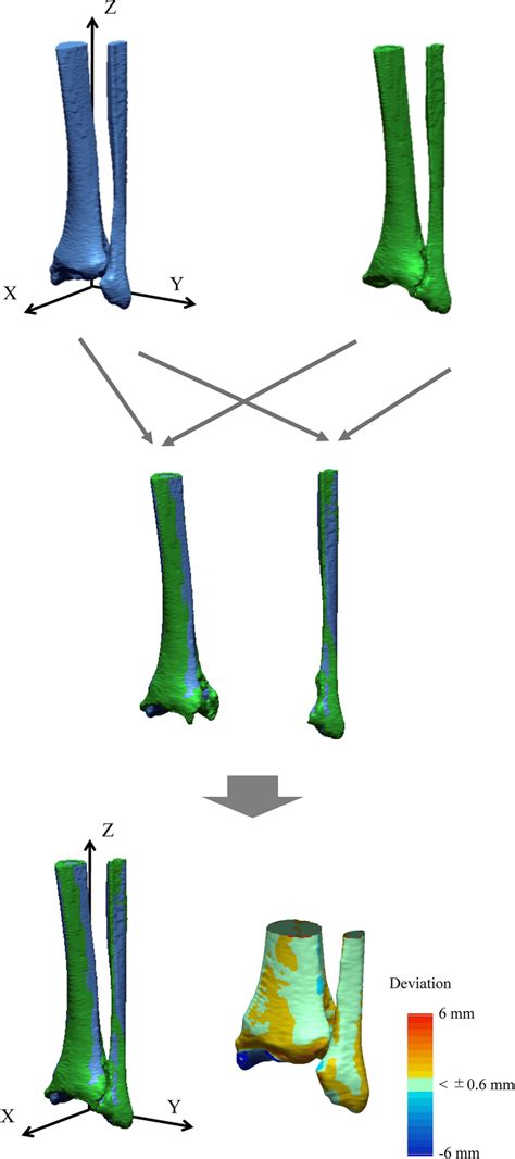Leftright Comparisons Of The Tibia And Fibula In Unilateral Varus