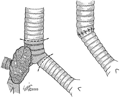 Extended Pulmonary Resection By Sleeve Lobectomy And Carinal