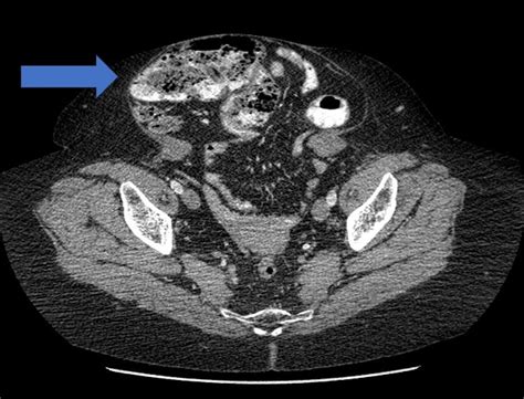 Abdominal Hernia Maher A Abbas Md Proctologist Colorectal Surgeon