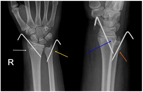A Case Of Combined Epiphyseal Injury To Distal Ulna Salter Harris I