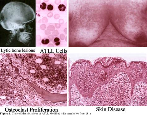 Pdf Adult T Cell Leukemia Lymphoma Semantic Scholar