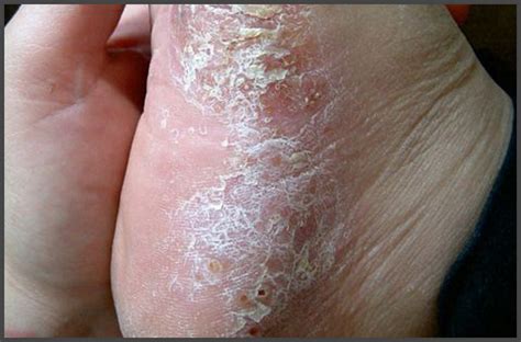 Psoriasis On Soles Of Feet Pictures Psoriasis Expert