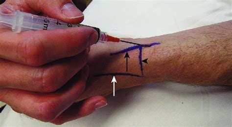 Patients with de quervain's tenosynovitis demonstrate a positive finkelstein test result. First dorsal compartment injection (de Quervain's ...