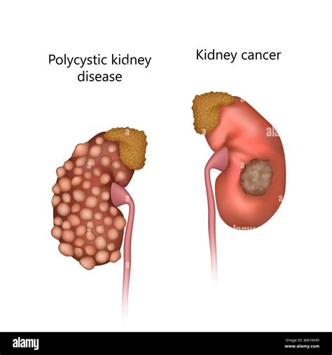 Polycystic Kidney Disease High Resolution Stock Photography And Images