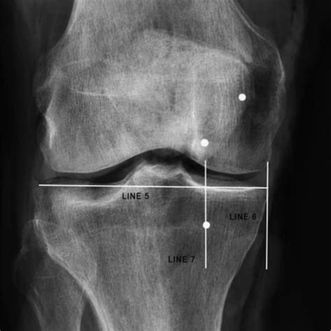 Anatomic Study Of The Medial Patellotibial Ligament Mptl Of A Right