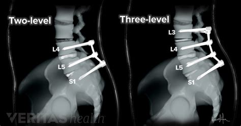 Multilevel Spinal Fusion For Low Back Pain