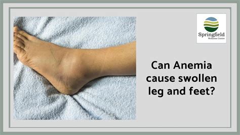 Can Anemia Cause Swollen Leg And Feet Dr Maran On Pitting Pedal