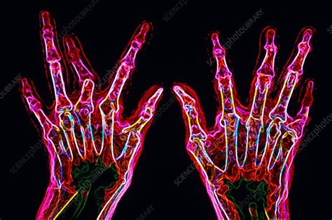 Arthritic Hands X Ray Stock Image M1100491 Science Photo Library