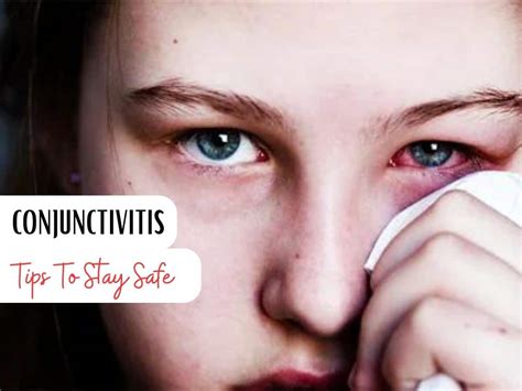 Conjunctivitis Spreading Rapidly In India 10 Tips To Prevent Eye Flu