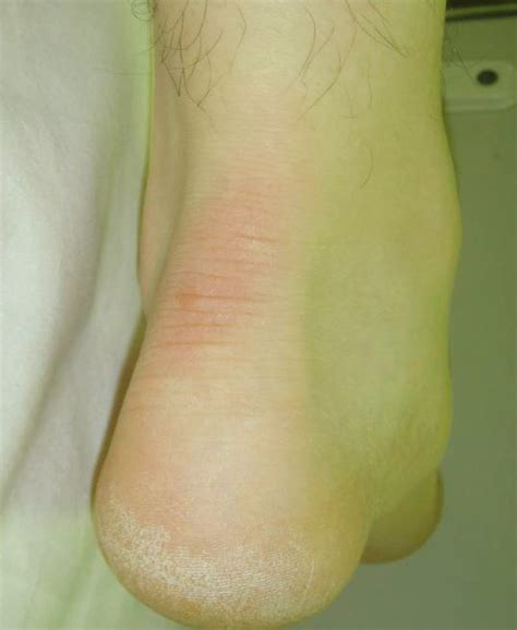 Close Up Photograph Of The Left Ankle Redness And Swelling Of The Skin