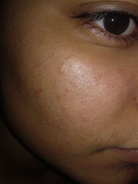 Red Small Pimples And Weird Bumps On My Face Please Help General