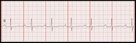 Ekg Rhythm Strip Quiz 147 Interval Measurements