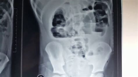Intestinal Obstruction Erect N Supine Abdominal X Ray YouTube