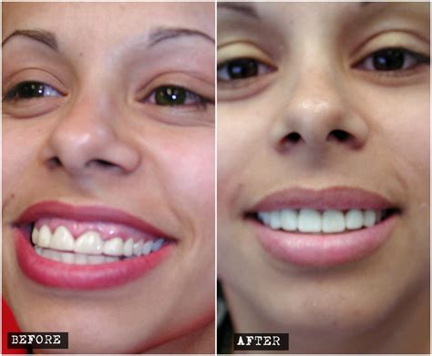 After your braces come off, the orthodontist will thoroughly clean your teeth. Mary wanted treatment for her overgrown gums and small ...