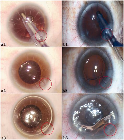 A1 B1 Radial Keratotomy Rk Incision Dehiscence During The Surgery Download Scientific