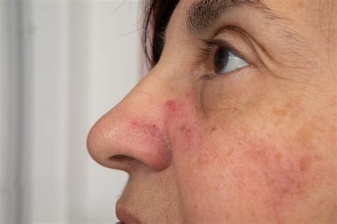Premium Photo Redness And Visible Blood Vessels On Woman Face Skin