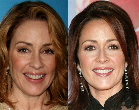 Patricia Heaton Plastic Surgery Before And After Pictures Face