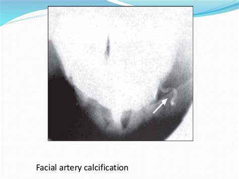 Soft Tissue Calcification Of Head And Neck