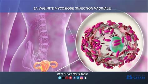La Vaginite Mycosique Infection Vaginale Laboratoires Salem My Xxx
