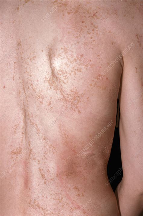 Epidermal Nevus Syndrome Stock Image C0494404 Science Photo Library