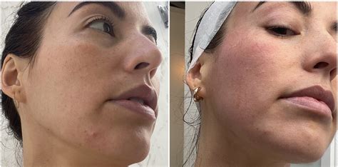 I Got A Cryo Facial See Before And After Photos Popsugar Beauty