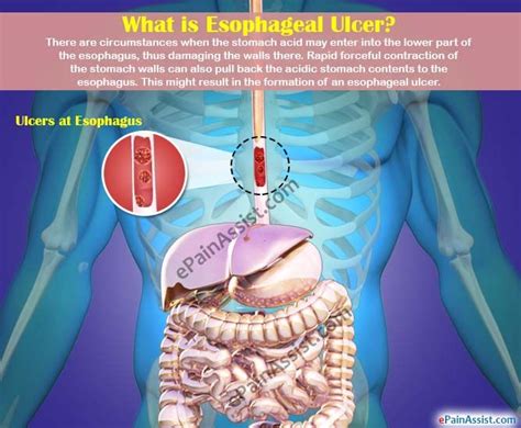 Esophageal Ulcercausessymptomstreatmenthealing Timediet Stomach