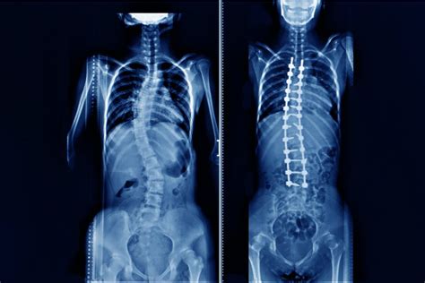Scoliosis Uoa Nj Spinal Orthopedics