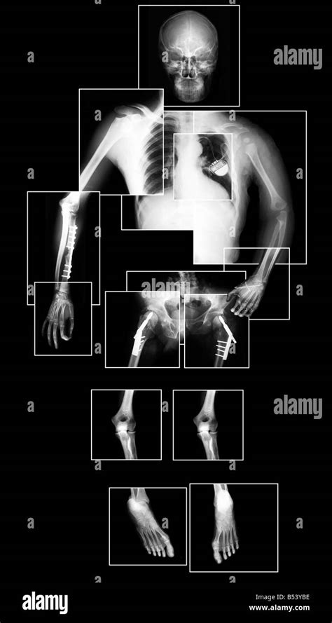 Composition complète d x ray photo du corps humain Photo Stock Alamy