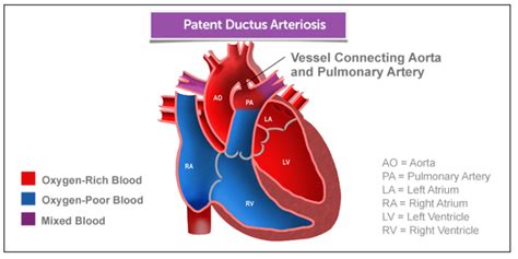 Patent Ductus Arteriosus Pda Is A Third Type Of Left To Right Shunt