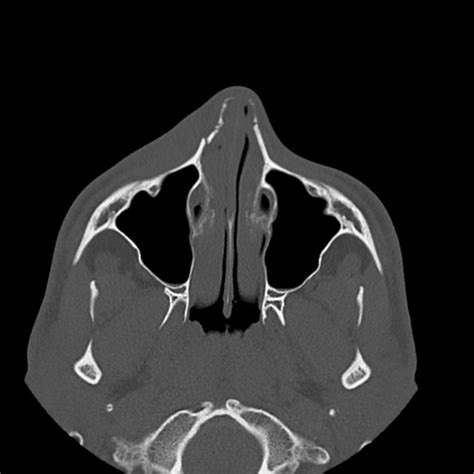 Nasal Bone Fracture Radiology Reference Article