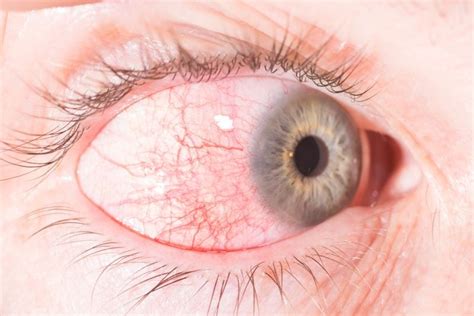 13 Causes Of Red Eye Facty Health