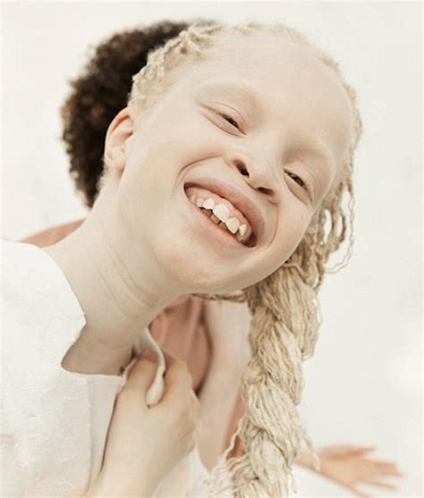 These Stunning Twins With Albinism Are Taking The Modeling Industry By Storm Allure