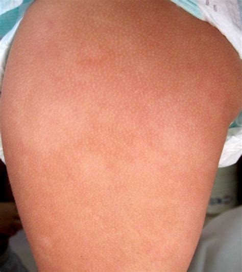 Based on studies, the skin disorder is often seen in children ages 6 to 12. pitiriasis alba 3 - Doctora Lorea Bagazgoitia Dermatología