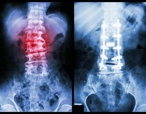 The Lumbar Spine Anatomy Function And Common Injuries Spine Center
